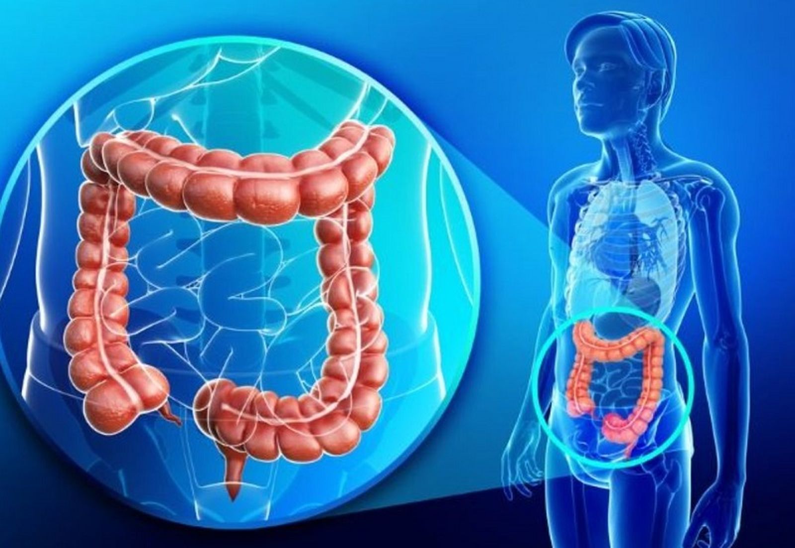 1732_cancer-de-colon-1200x900