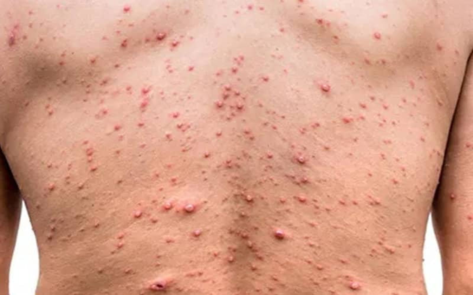 621_marruecos-viruela-mono